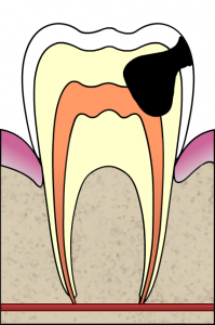 Når bakteriene har nådd røttene i tannen (det sorte feltet møter det oransje), er det tid for en rotfylling.